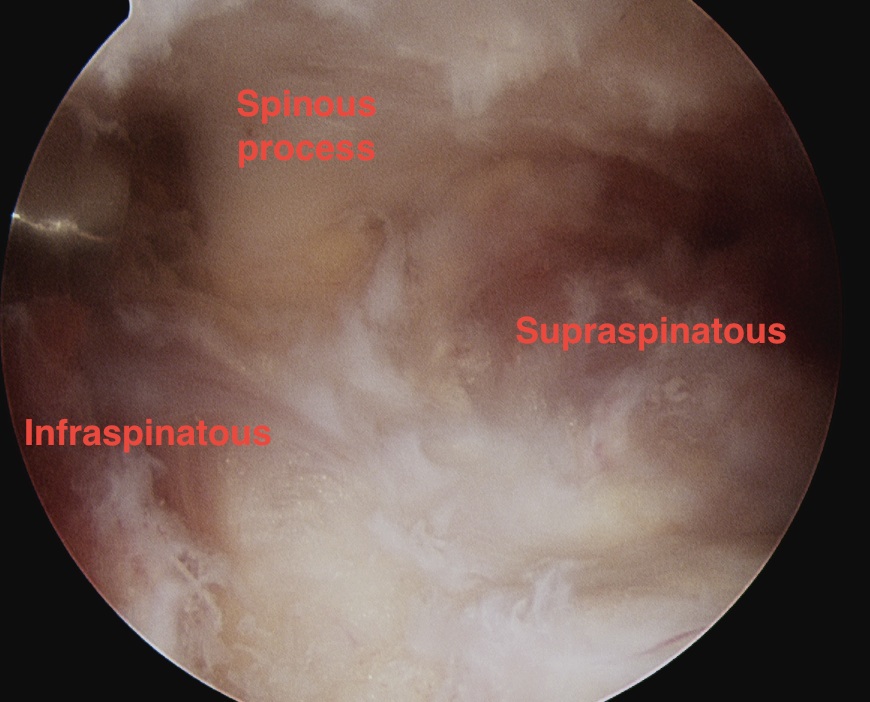 Subacromial Spinous Process 1